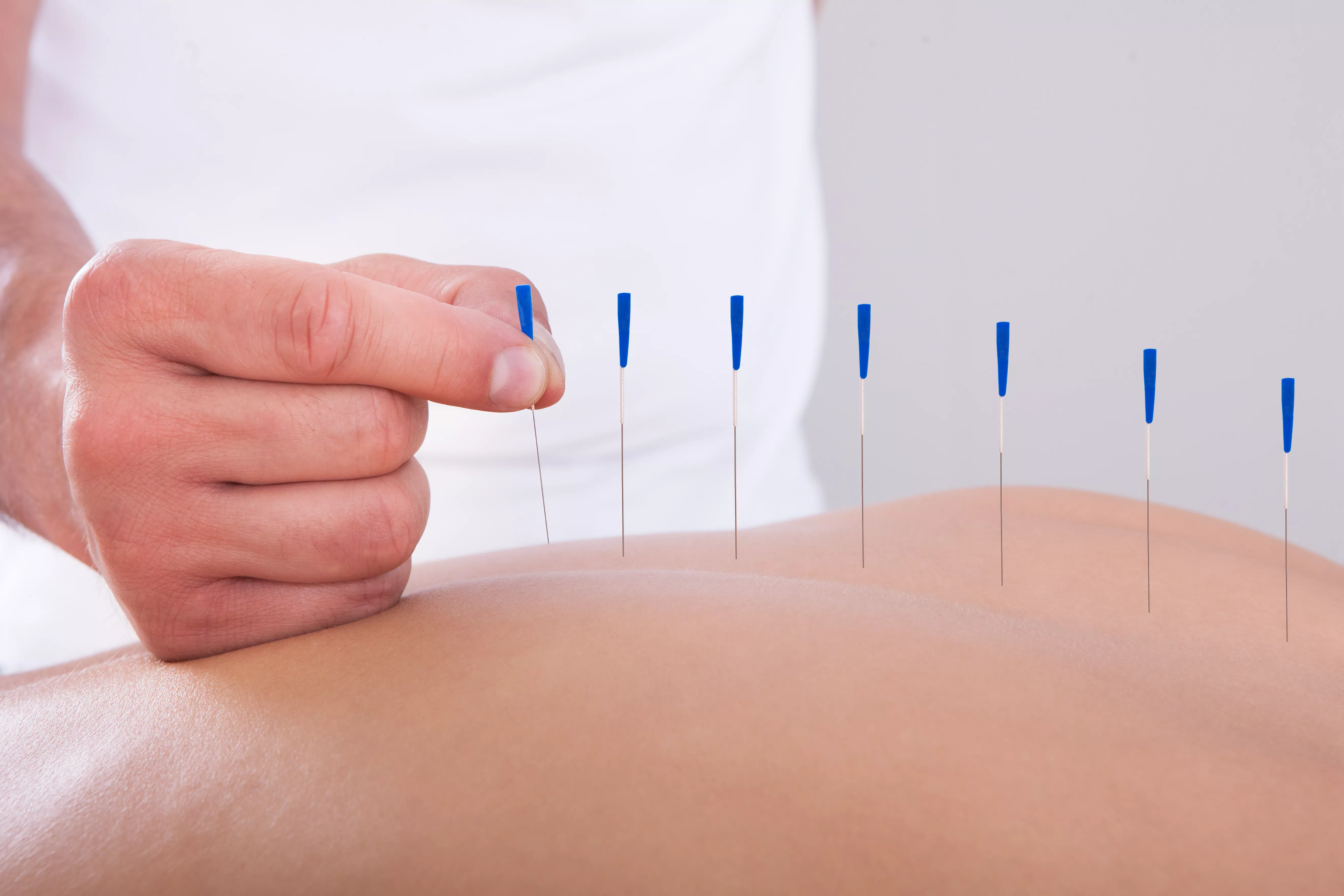 Dry Needling being put into back